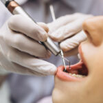 Caries activas o inactivas: diferencias y tratamientos para cada caso