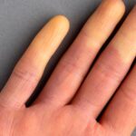 ¿Qué es el síndrome de Raynaud y por qué es más frecuente en las mujeres?