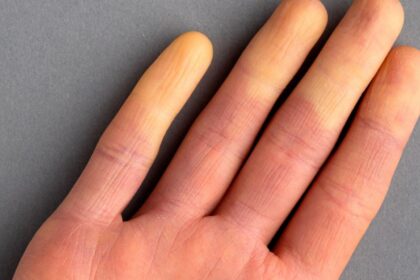 ¿Qué es el síndrome de Raynaud y por qué es más frecuente en las mujeres?