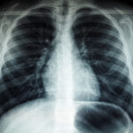 ¿Qué es el adenocarcinoma pulmonar, el tipo de cáncer que le diagnosticaron al papa León XIV?