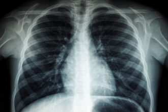 ¿Qué es el adenocarcinoma pulmonar, el tipo de cáncer que le diagnosticaron al papa León XIV?