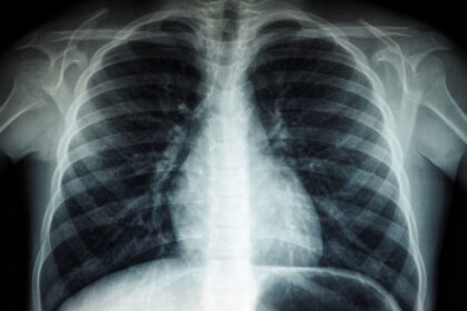 ¿Qué es el adenocarcinoma pulmonar, el tipo de cáncer que le diagnosticaron al papa León XIV?
